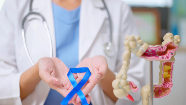 Tumore colon, dopo la chirurgia prelievi di sangue aiuteranno a capire rischio recidive