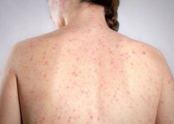 Morbillo, l’allarme dell’infettivologo Andreoni: “Casi in crescita, ricoveri frequenti negli adulti”