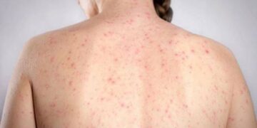 Morbillo, l’allarme dell’infettivologo Andreoni: “Casi in crescita, ricoveri frequenti negli adulti”