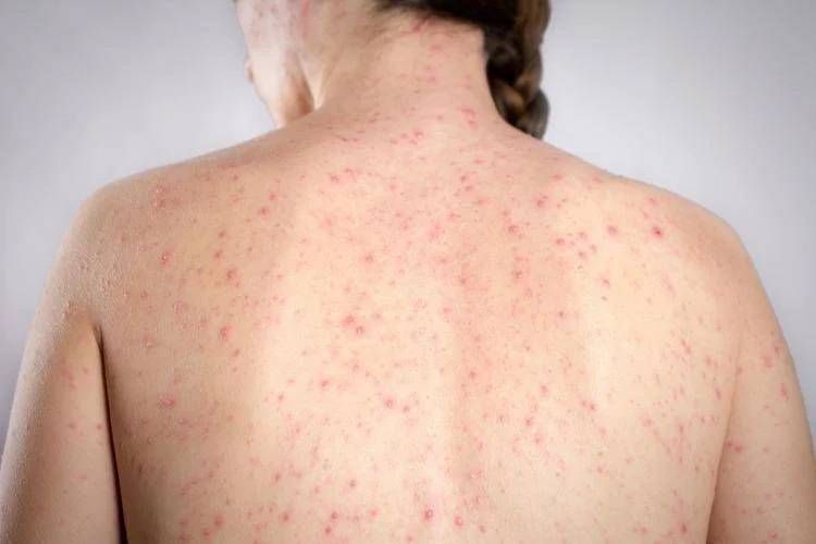 Morbillo, l’allarme dell’infettivologo Andreoni: “Casi in crescita, ricoveri frequenti negli adulti”